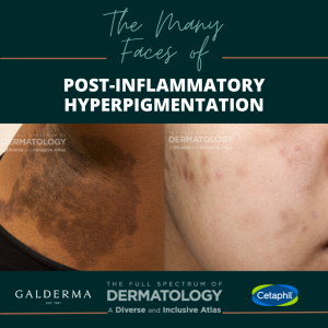 Inclusive Derm Atlas Post Inflammatory Hyperpigmentation PIH