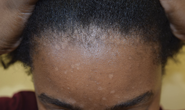 scaly scalp spots