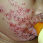 Eczema herpeticum