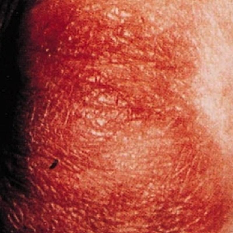 Atopic Dermatitis Images - JDDonline - Journal of Drugs in Dermatology