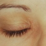 Eyelide Dermatitis