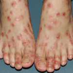 Atopic Dermatitis and Prurigo Nodularis