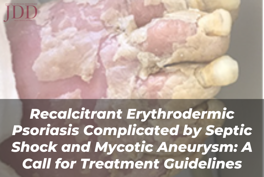 Journal of Drugs in Dermatology JDD article about recalcitrant erythrodermic psoriasis complicated by septic shock and mycotic aneurysm: a call for treatment guidelines