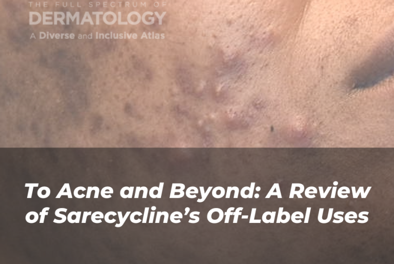 Journal of Drugs in Dermatology JDD article about acne and sarecycline’s off-label uses.