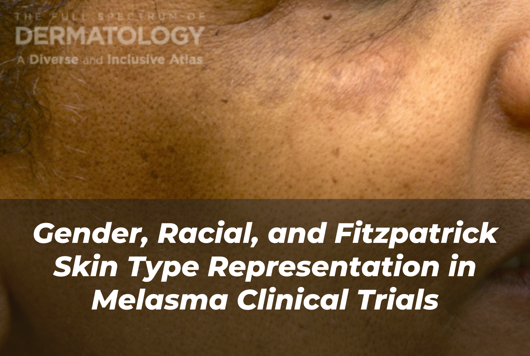 Journal of Drugs in Dermatology JDD Article About Gender, Racial, and Fitzpatrick Skin Type Representation in Melasma Clinical Trials. Image is from the Full Spectrum of Dermatology: A Diverse and Inclusive Atlas Online Gallery of a woman with a darker skin tone with pigmentary disorder melasma.