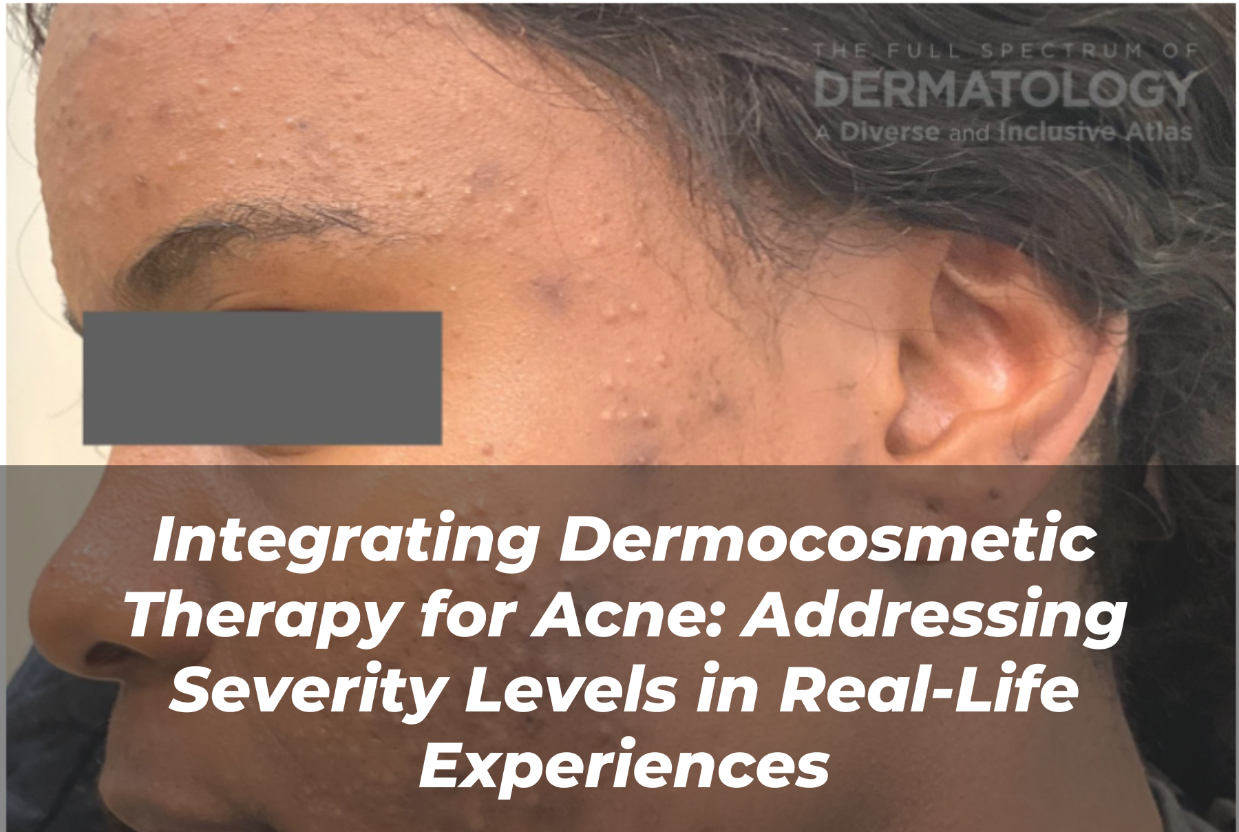 Journal of Drugs in Dermatology JDD Article About Integrating Dermocosmetic Therapy for Acne: Addressing Severity Levels in Real-Life Experience. Image is from the Full Spectrum of Dermatology: A Diverse and Inclusive Atlas Online Gallery of a darker skin tone with acne.