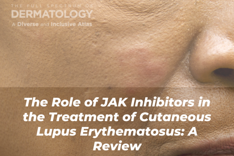 Journal of Drugs in Dermatology JDD Article About The Role of JAK Inhibitors in the Treatment of Cutaneous Lupus Erythematosus: A Review. Call out to the Inclusive Derm Atlas side by side image comparison page for acute cutaneous lupus erythematosus.