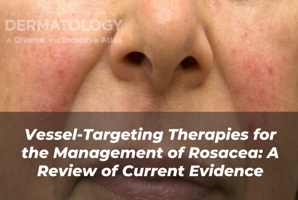 Journal of Drugs in Dermatology JDD Article About Vessel-Targeting Therapies for the Management of Rosacea: A Review of Current Evidence. Image is from the Full Spectrum of Dermatology: A Diverse and Inclusive Atlas Online Gallery of a woman with a darker skin tone with rosacea.