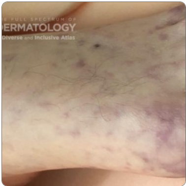 The Full Spectrum of Dermatology: A Diverse and Inclusive Atlas image collection for retiform purpura, showcasing the condition in multiple skin tones and types. Vascular, purpura dermatology skin condition. The Inclusive Derm Atlas, diversity and equity in skin. Skin of color included.