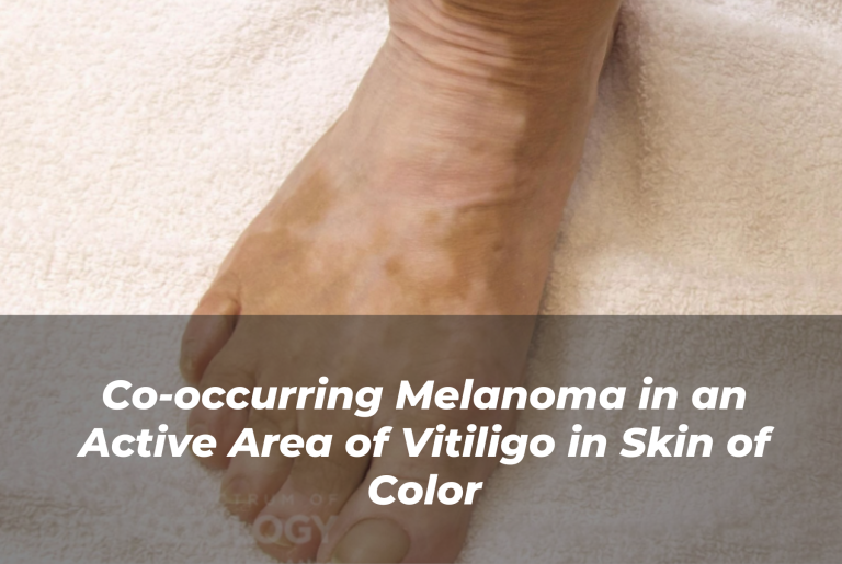 Journal of Drugs in Dermatology JDD Article About Co-occurring Melanoma in an Active Area of Vitiligo in Skin of Color. Image from The Full Spectrum of Dermatology: A Diverse and Inclusive Atlas which features side by side images of patients, even with skin of color, with vitiligo.