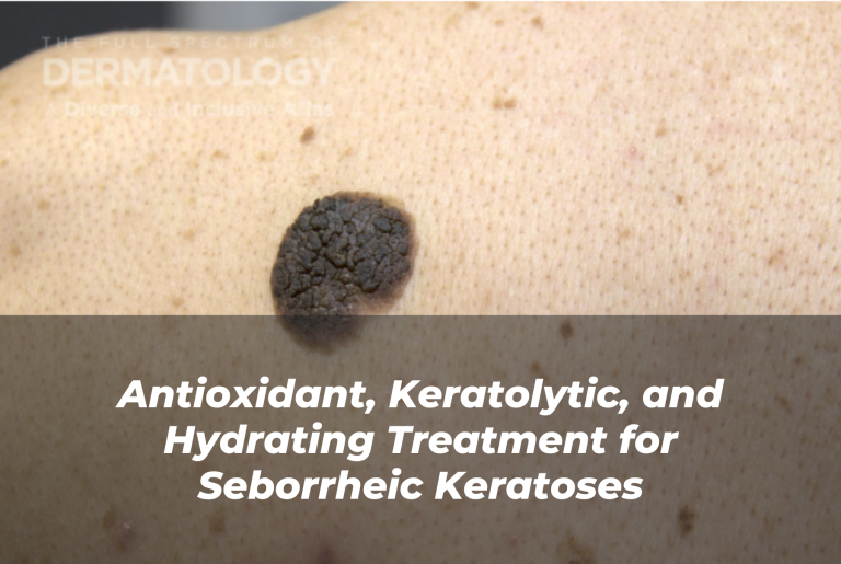 Journal of Drugs in Dermatology JDD Article About Antioxidant, Keratolytic, and Hydrating Treatment for Seborrheic Keratoses. Image from the Full Spectrum of Dermatology: A Diverse and Inclusive Atlas of a darker skin tone back or torso with a seborrheic keratoses.