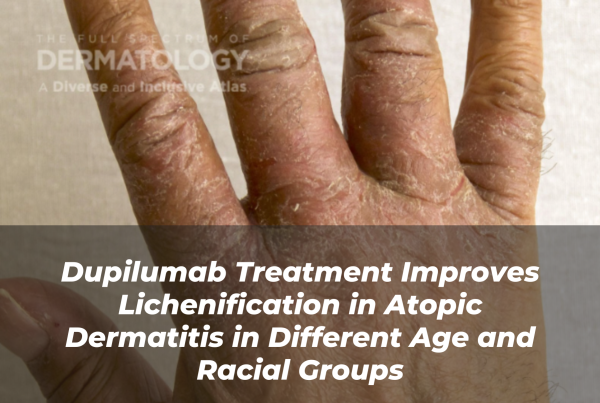 Journal of Drugs in Dermatology JDD Article About Dupilumab Treatment Improves Lichenification in Atopic Dermatitis in Different Age and Racial Groups. Image from the Full Spectrum of Dermatology: A Diverse and Inclusive Atlas. It is one of the images from a side by side comparison of full range skin tones of a hand with atopid dermatitis (AD).