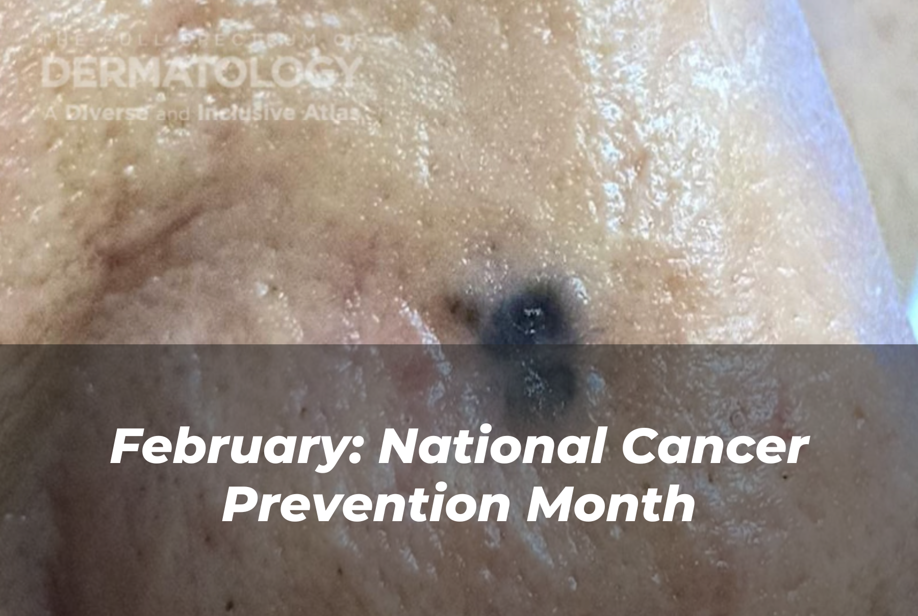 Journal of Drugs in Dermatology JDD About Cancer Prevention Month. Image from the Full Spectrum of Dermatology: A Diverse and Inclusive Atlas of a darker skin tone nose or face with a pigmented basal cell carcinoma.