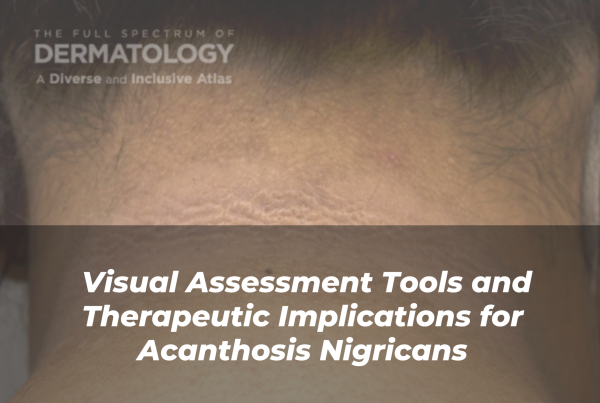 Journal of Drugs in Dermatology JDD Article About Visual Assessment Tools and Therapeutic Implications for Acanthosis Nigricans. Image is from the Full Spectrum of Dermatology: A Diverse and Inclusive Atlas that features acanthosis nigricans on a patient with darker skin tone.