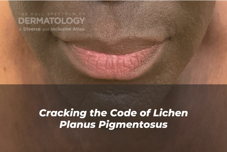 Journal of Drugs in Dermatology JDD About Lichen Planus Pigmentosus. Image from the Full Spectrum of Dermatology: A Diverse and Inclusive Atlas of a person with a darker skin tone with LPP.