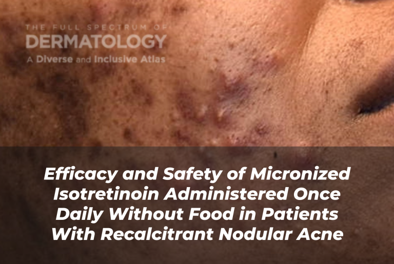 Journal of Drugs in Dermatology JDD About Efficacy and Safety of Micronized Isotretinoin Administered Once Daily Without Food in Patients With Recalcitrant Nodular Acne. Image from The Full Spectrum of Dermatology: A Diverse and Inclusive Atlas of a darker skin tone patient with acne.