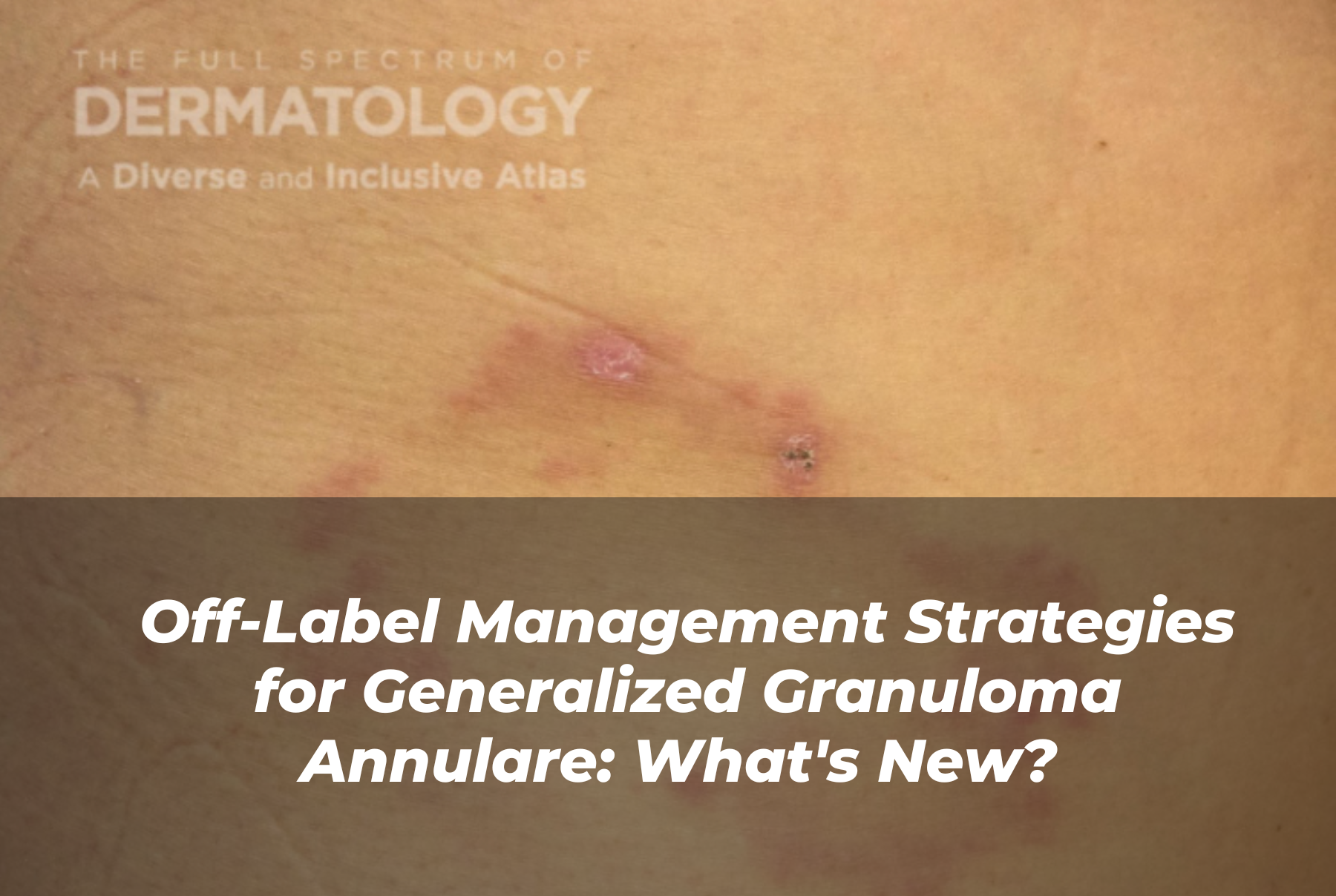 Journal of Drugs in Dermatology JDD Article About Off-Label Management Strategies for Generalized Granuloma Annulare: What's New?
