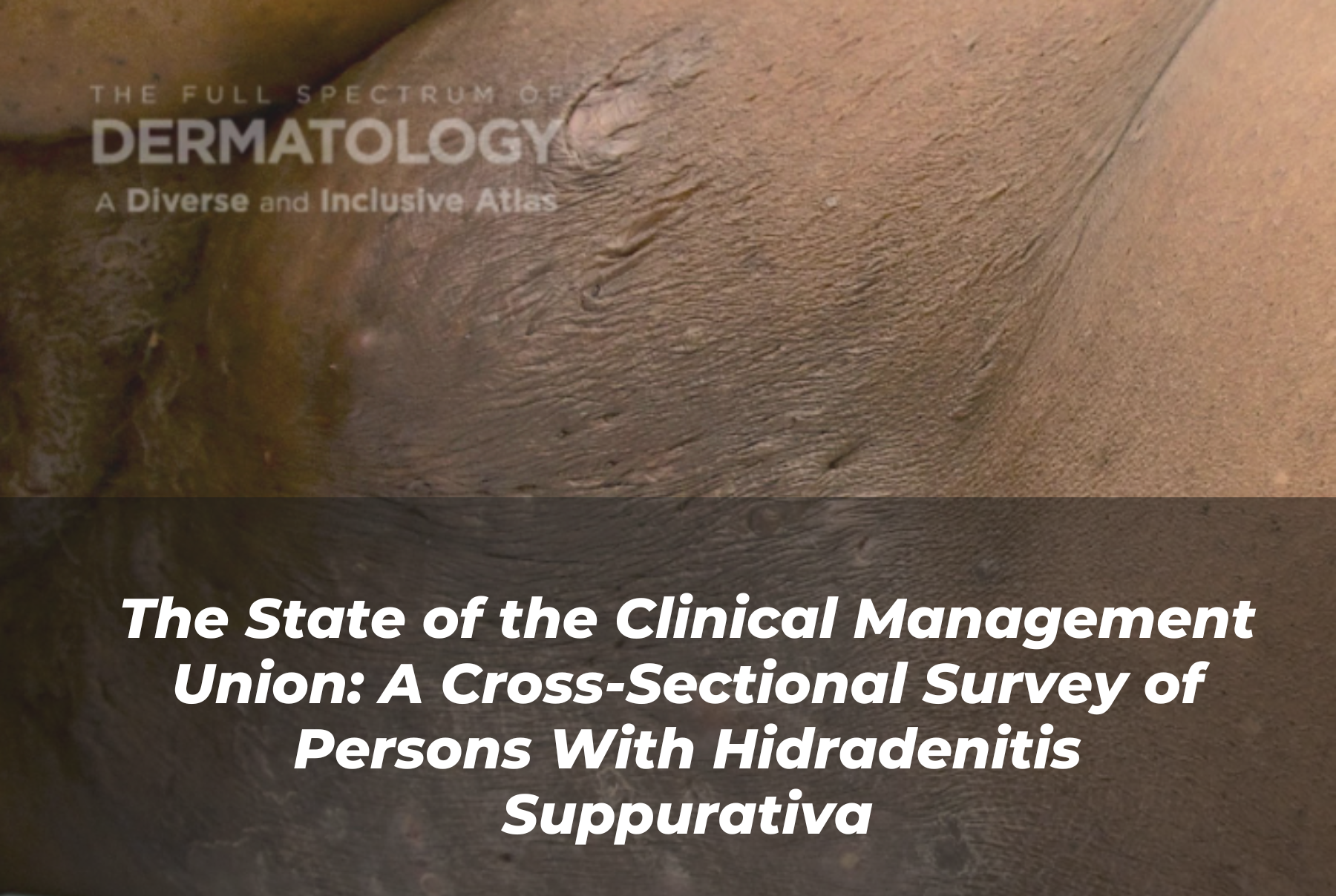 Journal of Drugs in Dermatology JDD Article About The State of the Clinical Management Union: A Cross-Sectional Survey of Persons With Hidradenitis Suppurativa