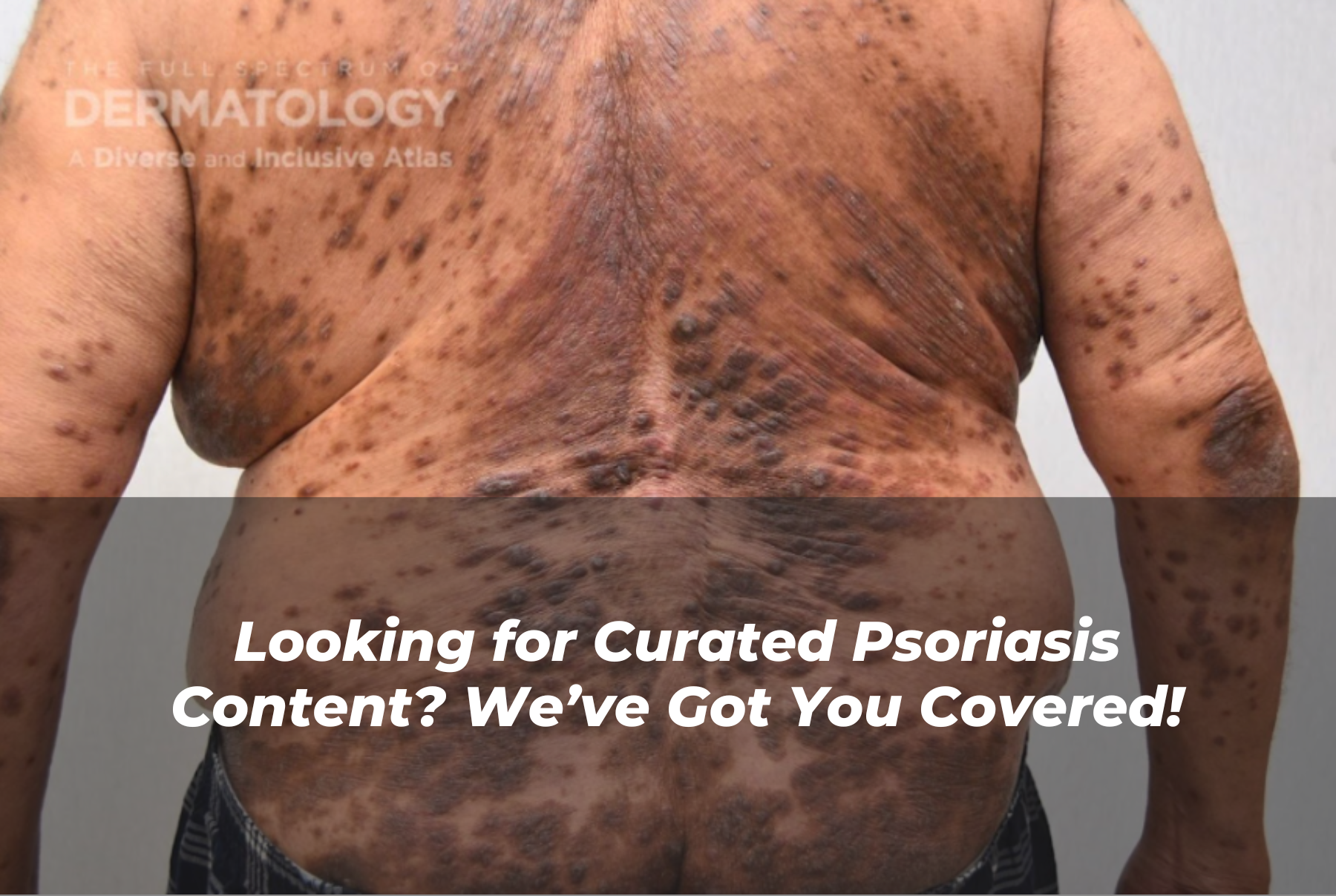 Journal of Drugs in Dermatology JDD Article About Looking for Curated Psoriasis Content? We’ve Got You Covered!