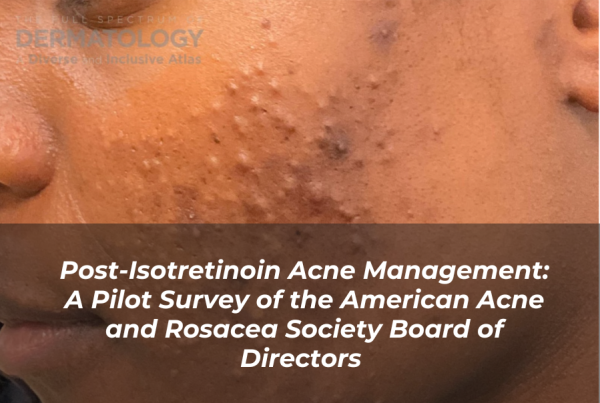 Journal of Drugs in Dermatology JDD Article About A Review of the Role of C. Acnes and its Biofilm in Dandruff Pathogenesis. Image from the Full Spectrum of Dermatology: A Diverse and Inclusive Atlas featuring a woman with a deep skin tone with acne on her cheek. Post inflammatory hyperpigmentation is present.