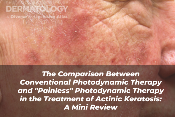 Journal of Drugs in Dermatology JDD Article About The Comparison Between Conventional Photodynamic Therapy and "Painless" Photodynamic Therapy in the Treatment of Actinic Keratosis: A Mini Review. Image from the Full Spectrum of Dermatology: A Diverse and Inclusive Atlas of a light skin tone person with actinic keratosis and erythema.
