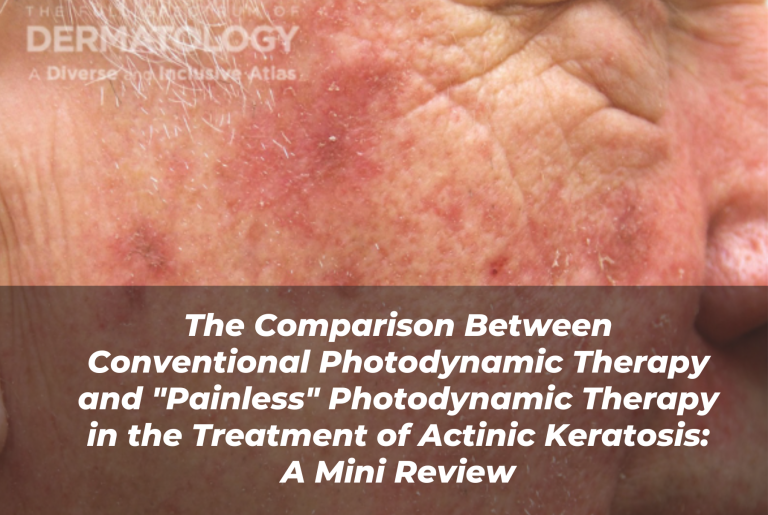 Journal of Drugs in Dermatology JDD Article About The Comparison Between Conventional Photodynamic Therapy and "Painless" Photodynamic Therapy in the Treatment of Actinic Keratosis: A Mini Review. Image from the Full Spectrum of Dermatology: A Diverse and Inclusive Atlas of a light skin tone person with actinic keratosis and erythema.