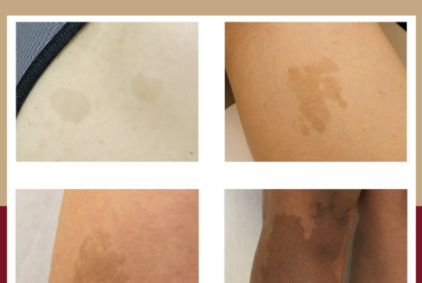 Journal of Drugs in Dermatology JDD About The Full Spectrum of Dermatology: A Diverse and Inclusive Atlas. The images is of keloid among different skin tones