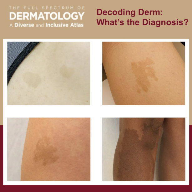 Journal of Drugs in Dermatology JDD About The Full Spectrum of Dermatology: A Diverse and Inclusive Atlas. The images is of keloid among different skin tones