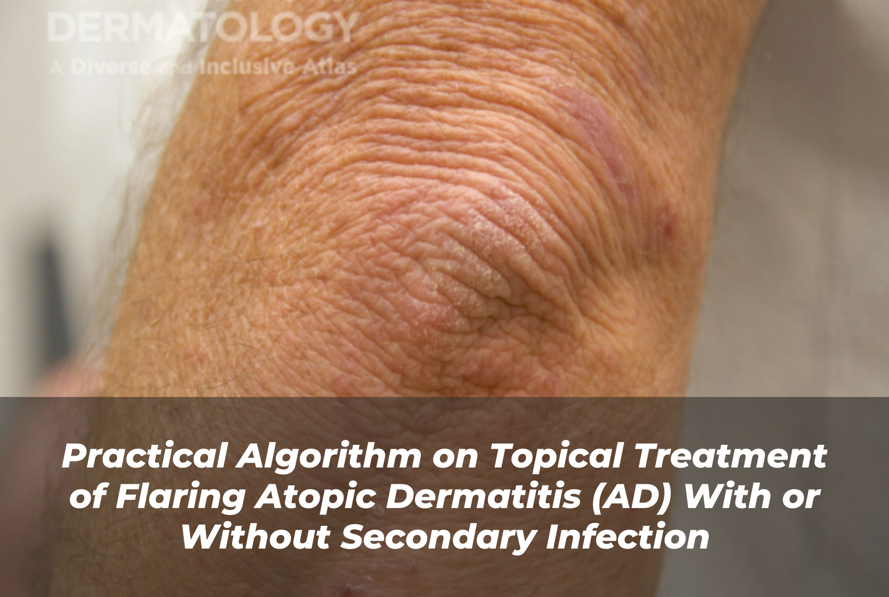 Journal of Drugs in Dermatology JDD Article About Practical Algorithm on Topical Treatment of Flaring Atopic Dermatitis (AD) With or Without Secondary Infection.