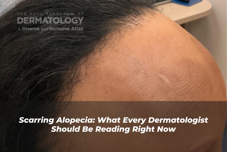Journal of Drugs in Dermatology JDD Article About Scarring Alopecia. Image is from the Full Spectrum of Dermatology: A Diverse and Inclusive Atlas. It is of a darker skin tone woman with black textured hair and a close up of her hairline to show hair loss.