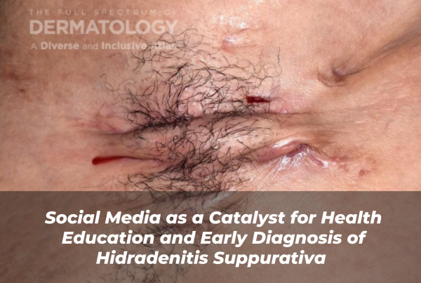 Journal of Drugs in Dermatology JDD Article About Social Media as a Catalyst for Health Education and Early Diagnosis of Hidradenitis Suppurativa. Image also from the Full Spectrum of Dermatology: A Diverse and Inclusive Atlas. It features a lighter skin tone patient who has HS under arm.