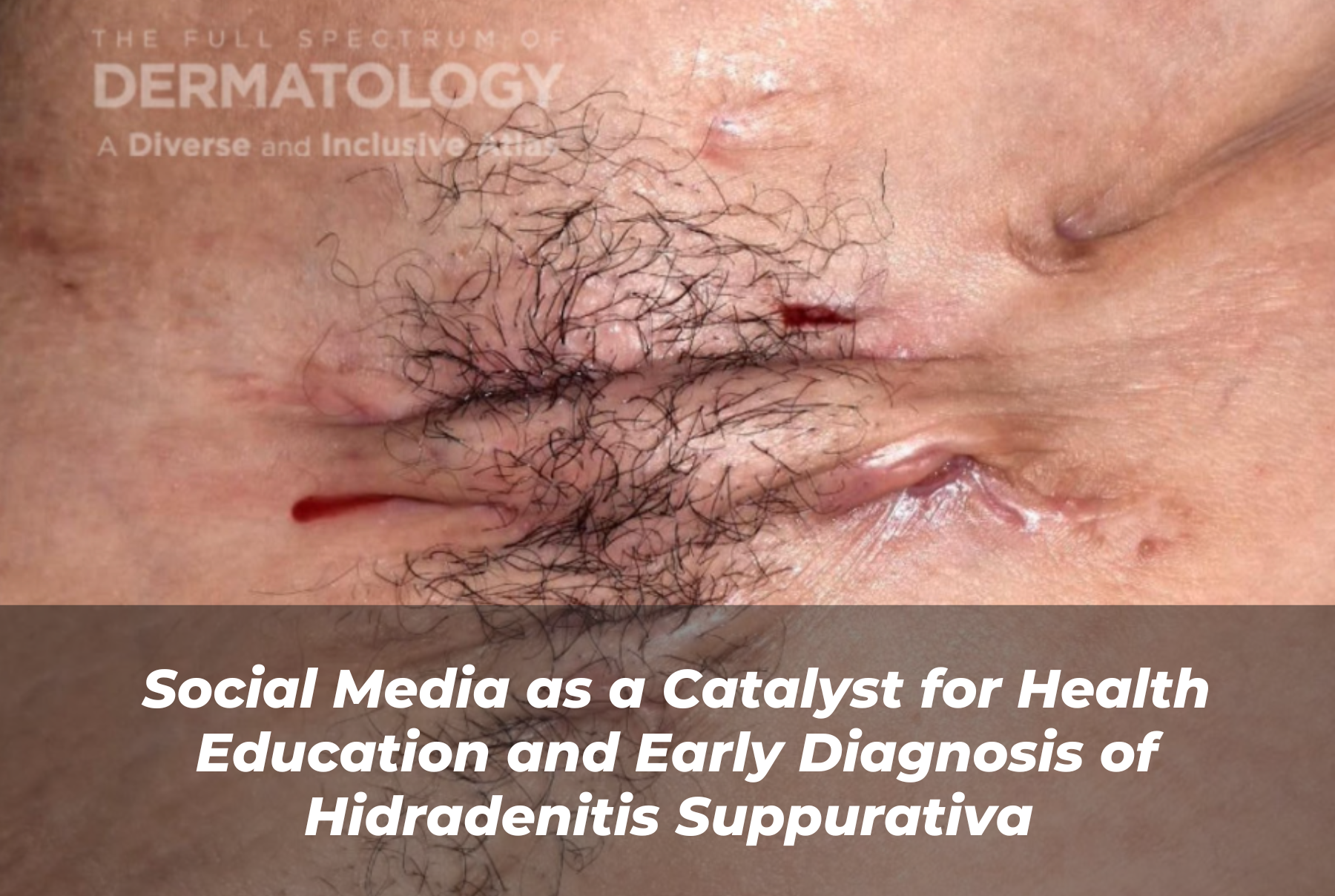 Journal of Drugs in Dermatology JDD Article About Social Media as a Catalyst for Health Education and Early Diagnosis of Hidradenitis Suppurativa. Image also from the Full Spectrum of Dermatology: A Diverse and Inclusive Atlas. It features a lighter skin tone patient who has HS under arm.