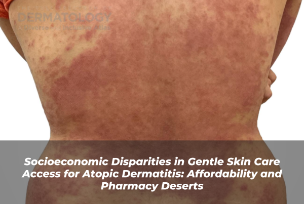 Journal of Drugs in Dermatology JDD Article About Socioeconomic Disparities in Gentle Skin Care Access for Atopic Dermatitis: Affordability and Pharmacy Deserts. Image is of deeper skin tone patient’s back covered with erythema, red atopic dermatitis.