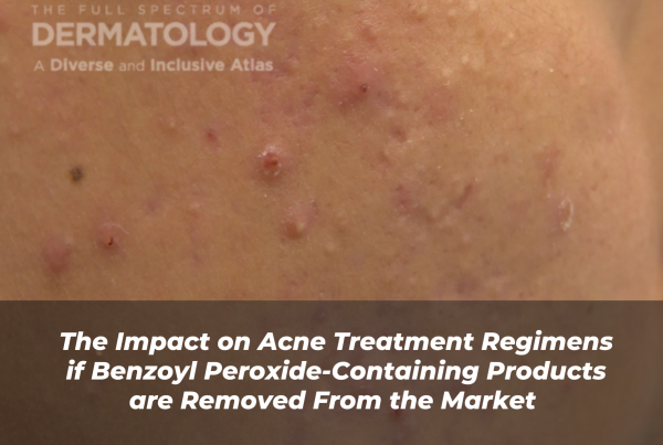 Journal of Drugs in Dermatology JDD Article About The Impact on Acne Treatment Regimens if Benzoyl Peroxide-Containing Products are Removed From the Market. Image from The Full Spectrum of Dermatology: A Diverse and Inclusive Atlas of a patient with skin of color who has acne and hyperpigmentation from acne scarring.
