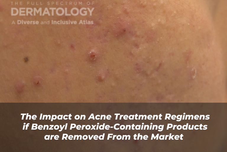 Journal of Drugs in Dermatology JDD Article About The Impact on Acne Treatment Regimens if Benzoyl Peroxide-Containing Products are Removed From the Market. Image from The Full Spectrum of Dermatology: A Diverse and Inclusive Atlas of a patient with skin of color who has acne and hyperpigmentation from acne scarring.