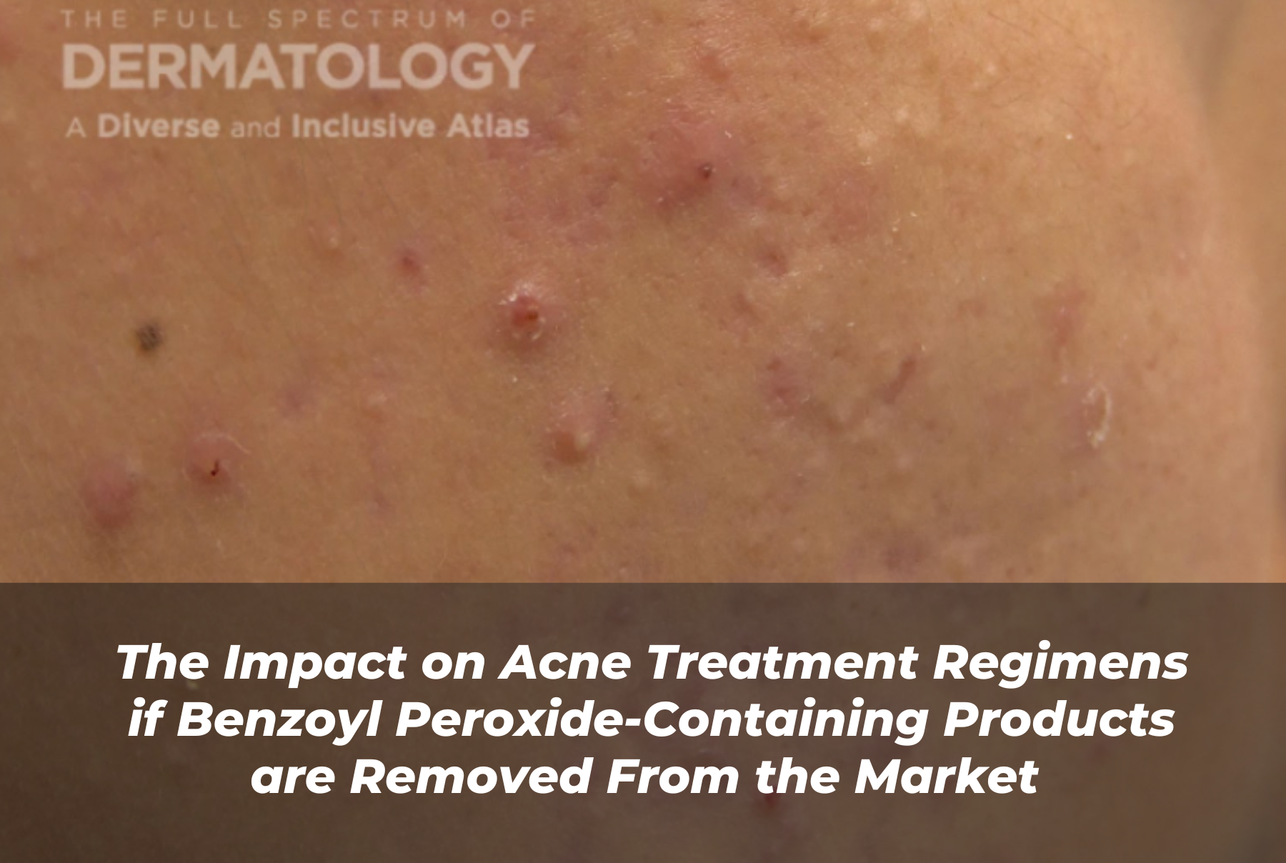 Journal of Drugs in Dermatology JDD Article About The Impact on Acne Treatment Regimens if Benzoyl Peroxide-Containing Products are Removed From the Market. Image from The Full Spectrum of Dermatology: A Diverse and Inclusive Atlas of a patient with skin of color who has acne and hyperpigmentation from acne scarring.