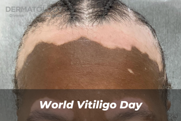 Journal of Drugs in Dermatology JDD Article About world vitiligo day. The image is from The Full Spectrum of Dermatology: A Diverse and Inclusive Atlas of a patient with skin of color who has vitiligo on the scalp, face, and forehead. The patient has darker skin tone.