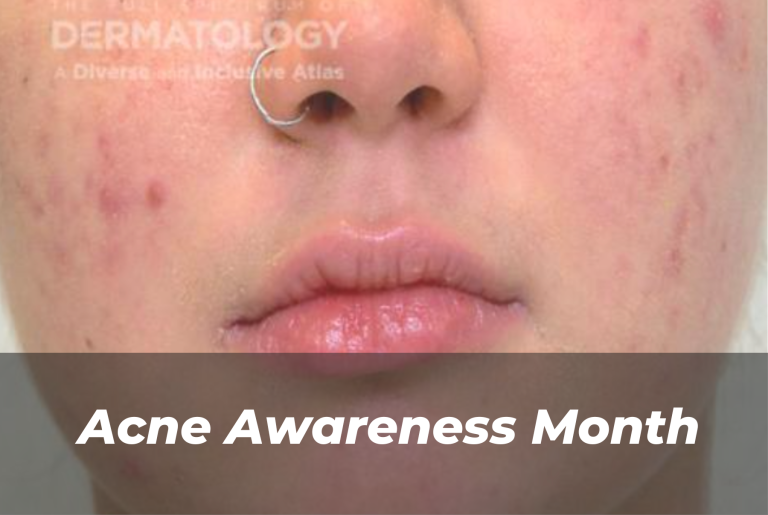 Journal of Drugs in Dermatology JDD Article About Acne Awareness Month. The image is from the Full Spectrum of Dermatology: A Diverse and Inclusive Atlas. It shows a pediatric patient with light skin tone and acne, along with hyperpigmentation.