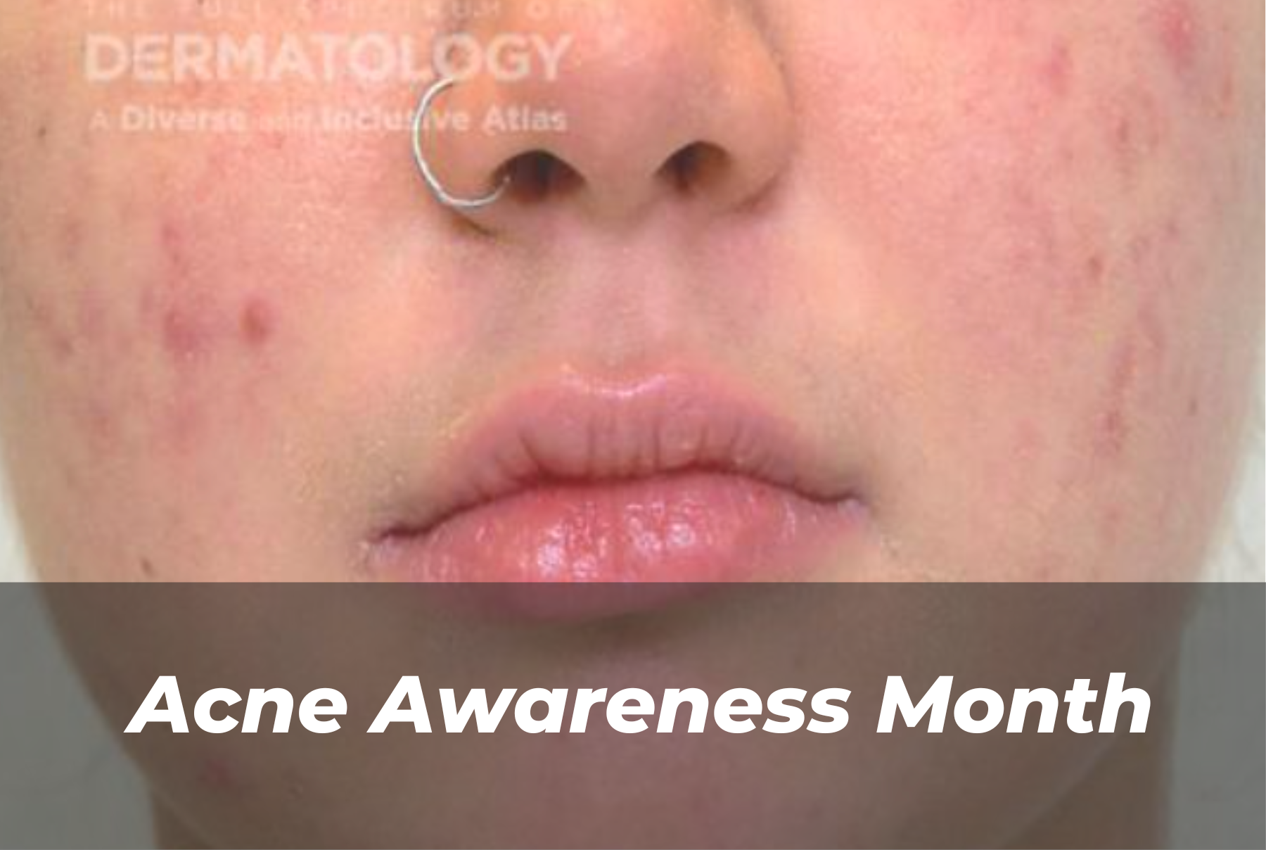 Journal of Drugs in Dermatology JDD Article About Acne Awareness Month. The image is from the Full Spectrum of Dermatology: A Diverse and Inclusive Atlas. It shows a pediatric patient with light skin tone and acne, along with hyperpigmentation.