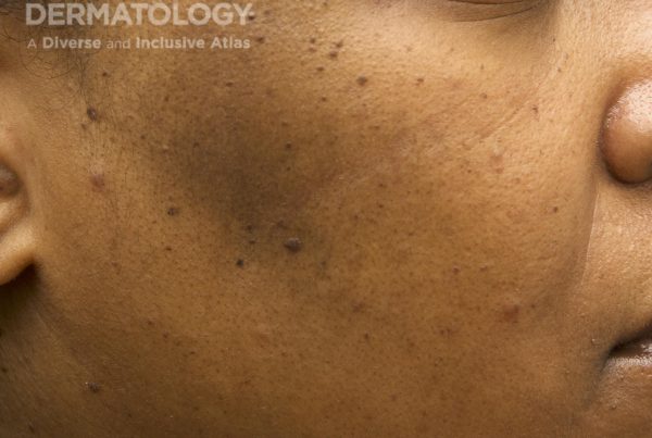 Journal of Drugs in Dermatology JDD Article About July Is Hyperpigmentation and Melasma Awareness Month. Image from the Full Spectrum of Dermatology: A Diverse and Inclusive Atlas of a patient with a deeper skin tone that has dyspigmentation or melasma on the face.