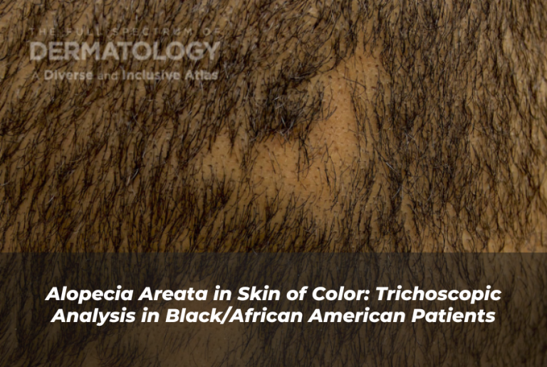 Journal of Drugs in Dermatology JDD Article About Alopecia Areata in Skin of Color: Trichoscopic Analysis in Black/African American Patients. Image is from the Full Spectrum of Dermatology: A Diverse and Inclusive Atlas of a patient with darker skin tone who has black hair and alopecia areata.
