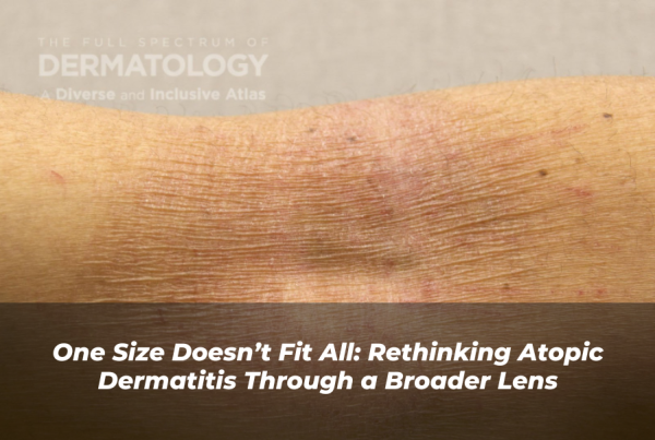 Journal of Drugs in Dermatology JDD Article About The Heterogeneity of Atopic Dermatitis. Image is from The Full Spectrum of Dermatology: A Diverse and Inclusive Atlas featuring a patient with a deeper skin tone with atopic dermatitis (AD).