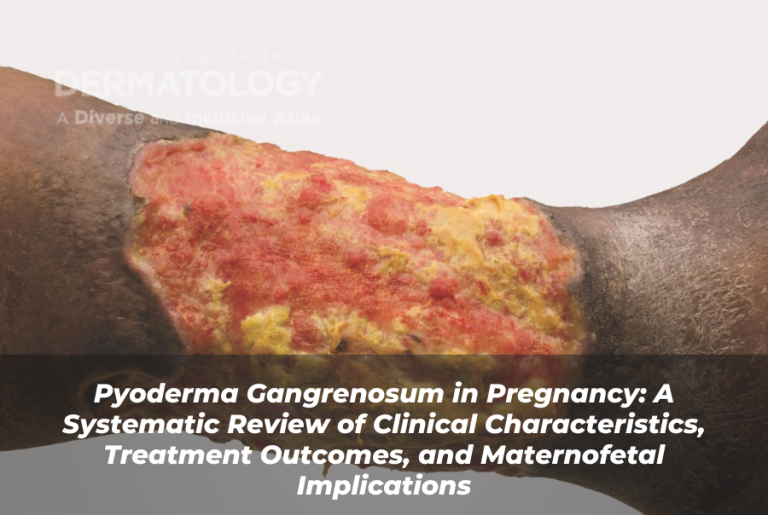 Journal of Drugs in Dermatology JDD Article About Pyoderma Gangrenosum in Pregnancy: A Systematic Review of Clinical Characteristics, Treatment Outcomes, and Maternofetal Implications. Image from the Full Spectrum of Dermatology: A Diverse and Inclusive Atlas. It is an image of exposed skin tissue and wound as a result of pyoderma gangrenosum. The patient has skin of color and the PG is on the leg.