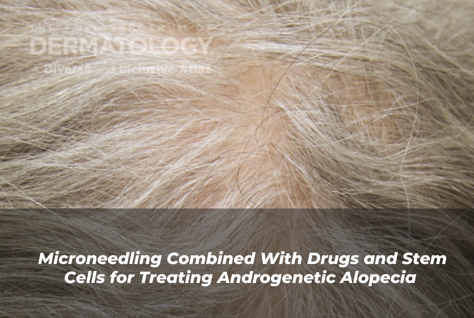 Journal of Drugs in Dermatology JDD Article About Microneedling Combined With Drugs and Stem Cells for Treating Androgenetic Alopecia