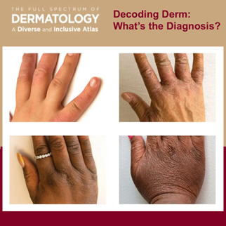 Journal of Drugs in Dermatology JDD About The Full Spectrum of Dermatology: A Diverse and Inclusive Atlas. The images is of atopic derm among different skin tones