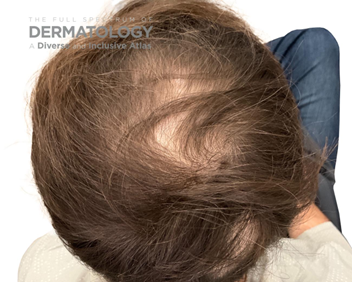 Journal of Drugs in Dermatology JDD Article About Alopecia Awareness Month 2025. Image is from The Full Spectrum of Dermatology: A Diverse and Inclusive Atlas on someone with androgenic alopecia, a non-scarring alopecia