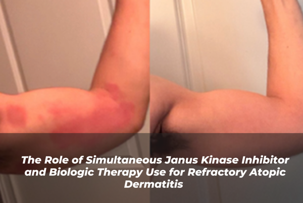 Journal of Drugs in Dermatology JDD Article About The Role of Simultaneous Janus Kinase Inhibitor and Biologic Therapy Use for Refractory Atopic Dermatitis. Arm and biceps of light skin pediatric patient with red or erythema atopic dermatitis before and after