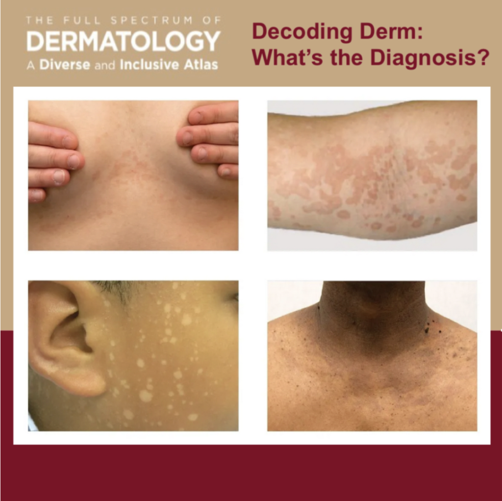 Journal of Drugs in Dermatology JDD About The Full Spectrum of Dermatology: A Diverse and Inclusive Atlas. The images is of tinea versicolor among different skin tones