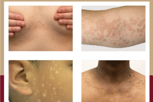 Journal of Drugs in Dermatology JDD About The Full Spectrum of Dermatology: A Diverse and Inclusive Atlas. The images is of tinea versicolor among different skin tones