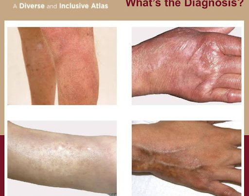 Journal of Drugs in Dermatology JDD About The Full Spectrum of Dermatology: A Diverse and Inclusive Atlas. The images is of morphea among different skin tones